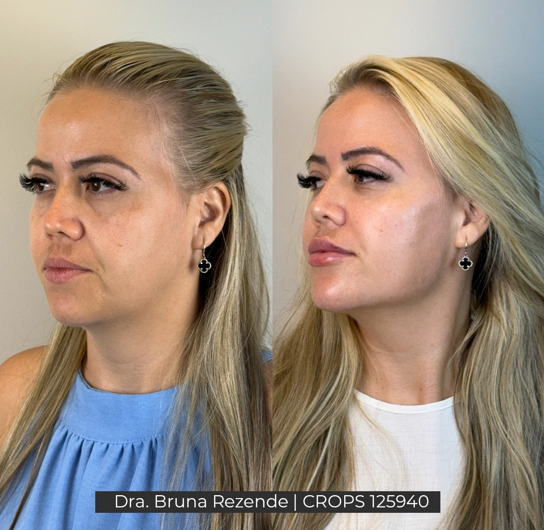Antes e Depois 11