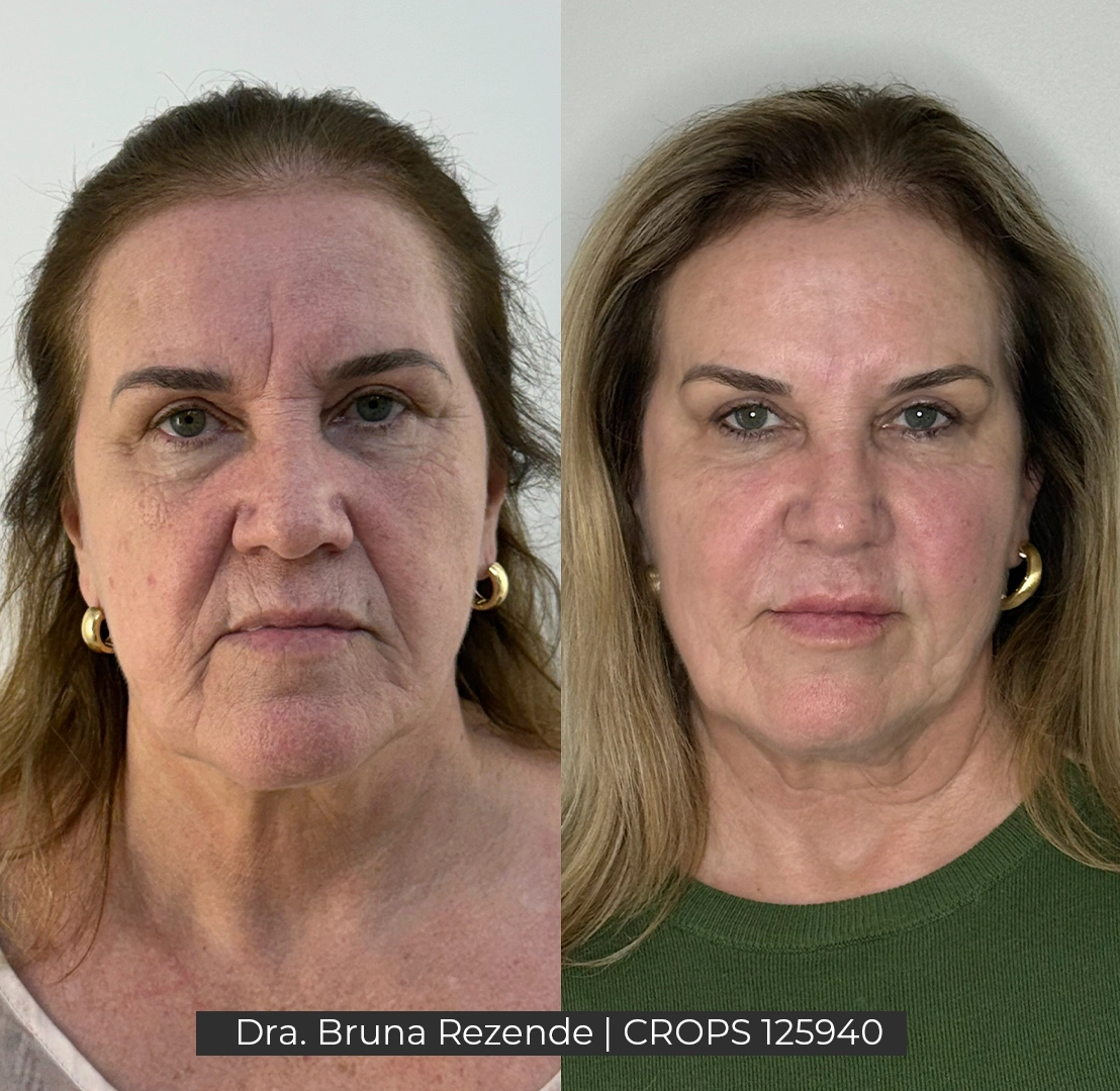 Antes e Depois 8